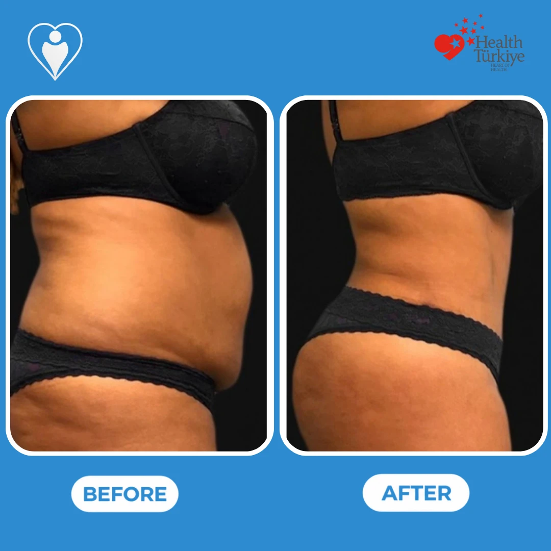 Body contouring in Turkey, before and after: side view of a woman's abdomen and flank before and a flatter profile after, patient of Dr. Jale Özdemir, Flymedi.
