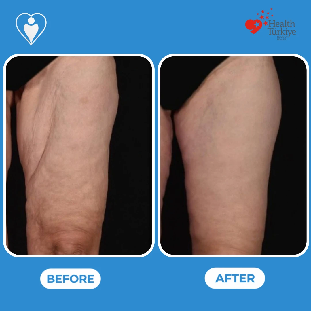 Thigh surgery before and after: side view of a thigh with loose, wrinkled skin before and a smoother contour after, patient of Dr. Jale Özdemir, Flymedi.