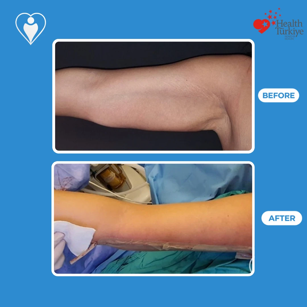 Arm surgery before and after: view of an outstretched upper arm with loose skin before and a slimmer arm on the operating table just after surgery, with a dressing, patient of Dr. Jale Özdemir, Flymedi.