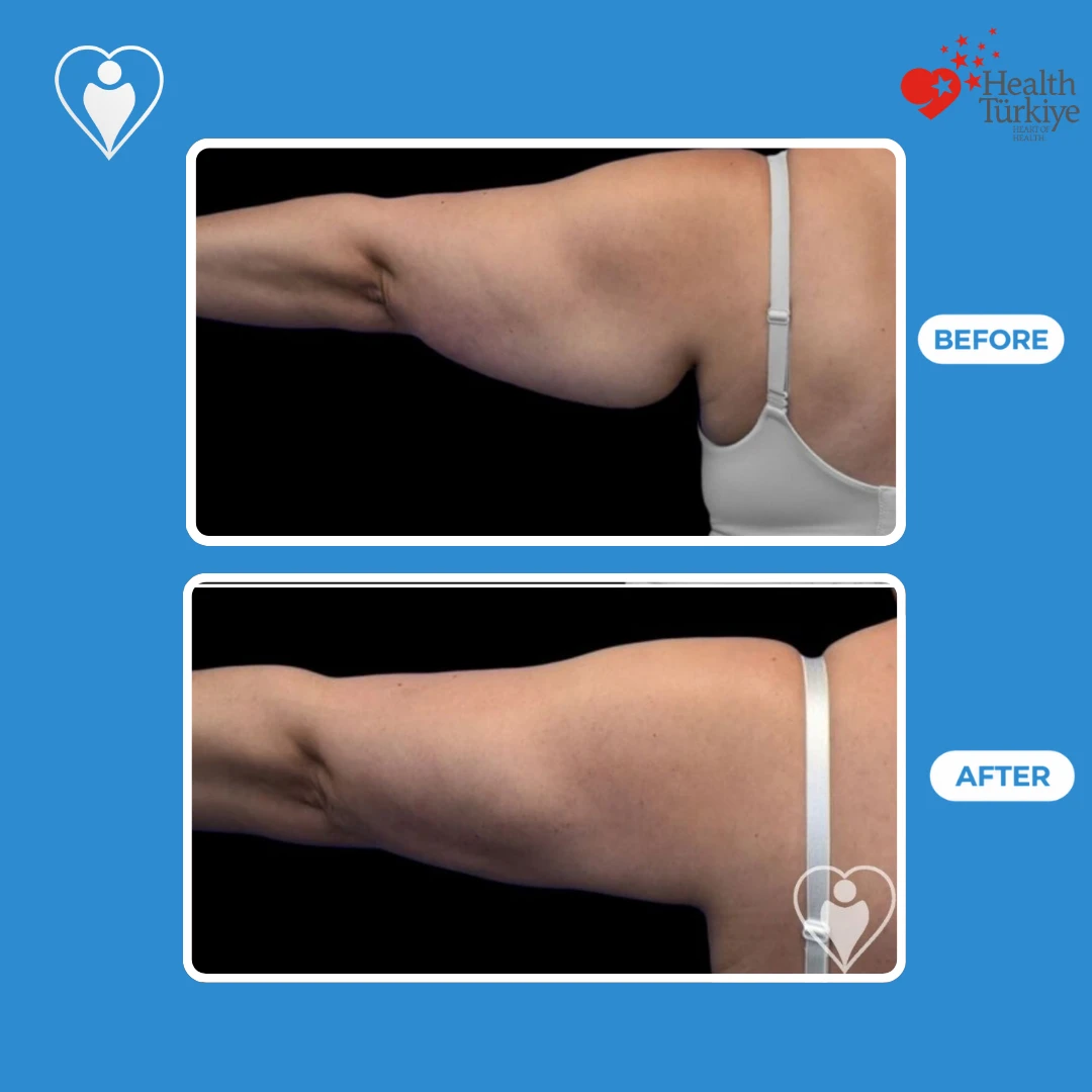 Arm surgery in Istanbul, before and after: back view of a woman's upper arm with hanging skin before and a slimmer, tighter contour after, patient of Dr. Jale Özdemir, Flymedi.