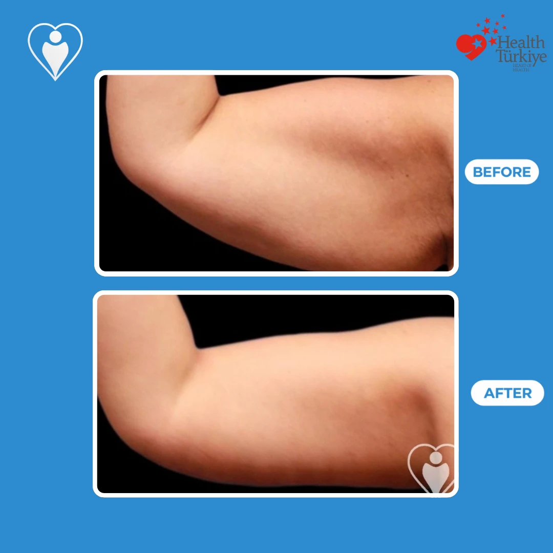 Arm contouring before and after: close view of a bent upper arm before and after, with a smoother, slimmer contour, patient of Dr. Jale Özdemir, Flymedi.