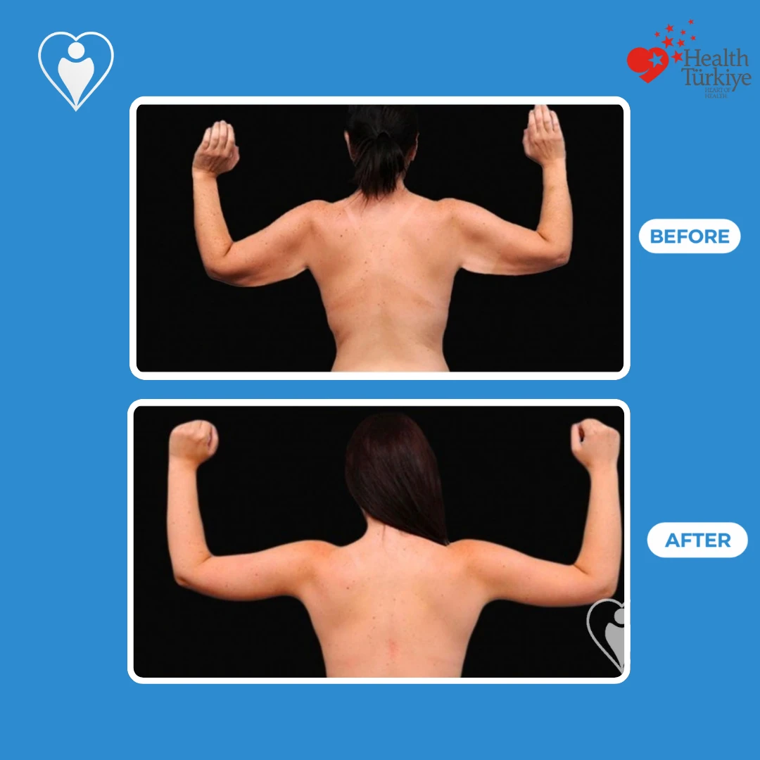 Arm surgery in Turkey, before and after: back view of a woman with raised arms before and after, with slimmer upper arms, patient of Dr. Jale Özdemir, Flymedi.