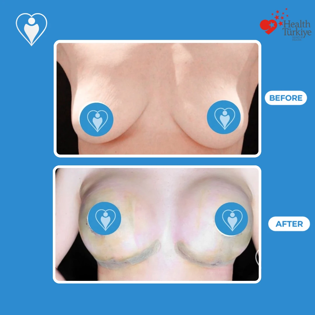 Breast surgery in Istanbul, before and after: front view of sagging breasts before and a fuller, lifted shape soon after surgery, with bruising and tape, patient of Dr. Jale Özdemir, Flymedi.