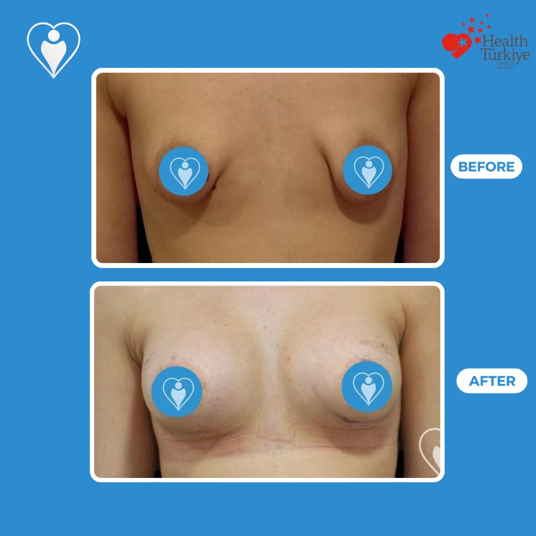 Breast surgery in Turkey, before and after: front view of narrow, pointed breasts before and a rounder shape soon after surgery, with fading marks, patient of Dr. Jale Özdemir, Flymedi.