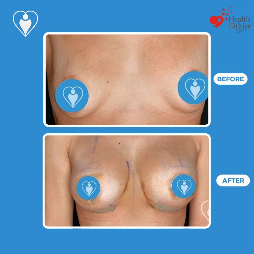 Cosmetic breast surgery before and after: front view of small breasts before and a fuller shape just after surgery, with skin markings and tape, patient of Dr. Jale Özdemir, Flymedi.