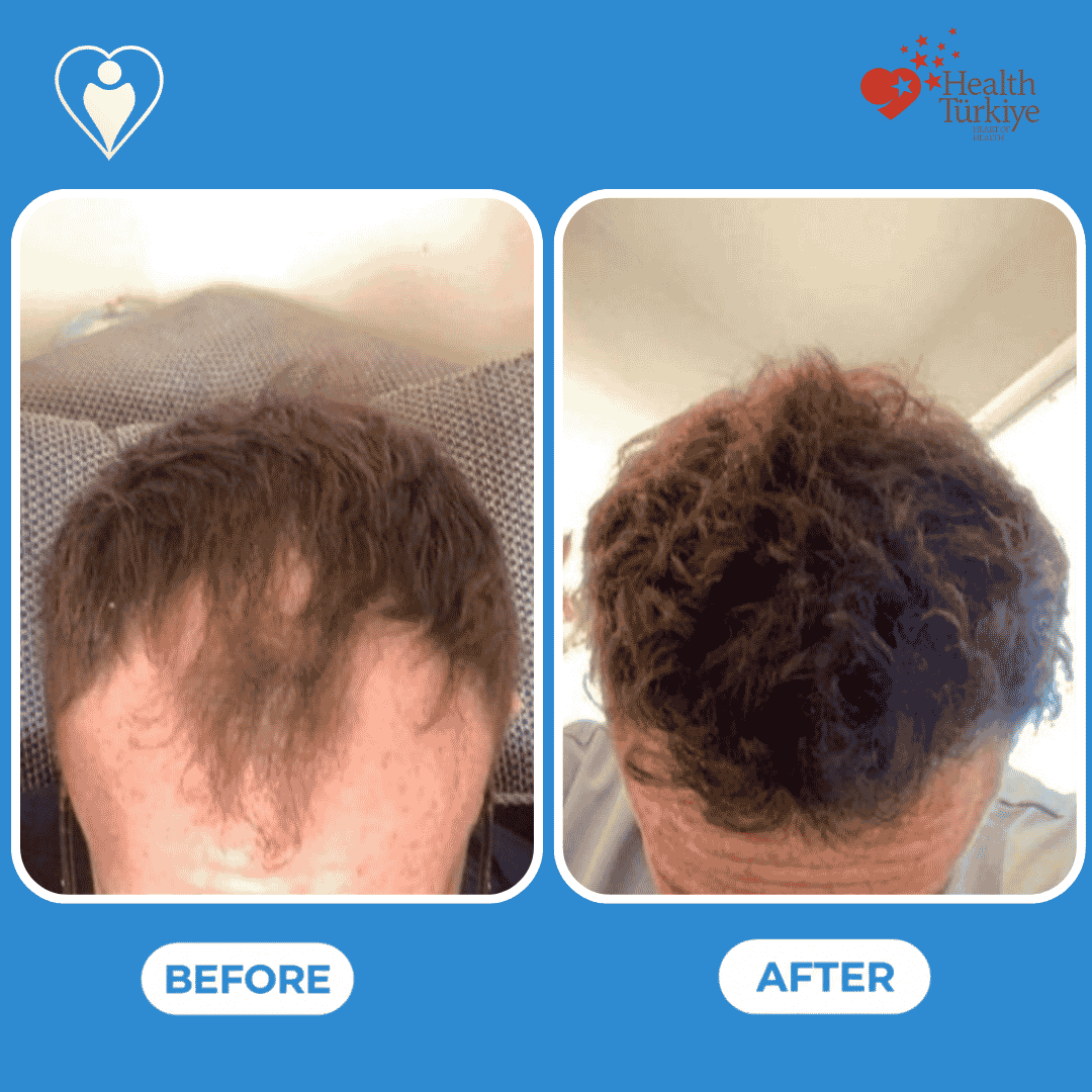 Before and after photos of a hair transplant procedure, front and top view of the hairline.