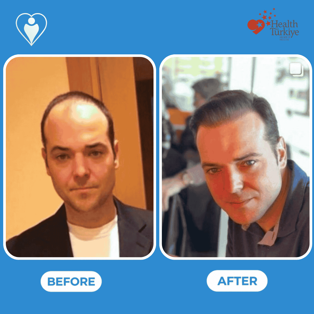 Before and after photos of a hair transplant procedure, top-down view of the scalp.