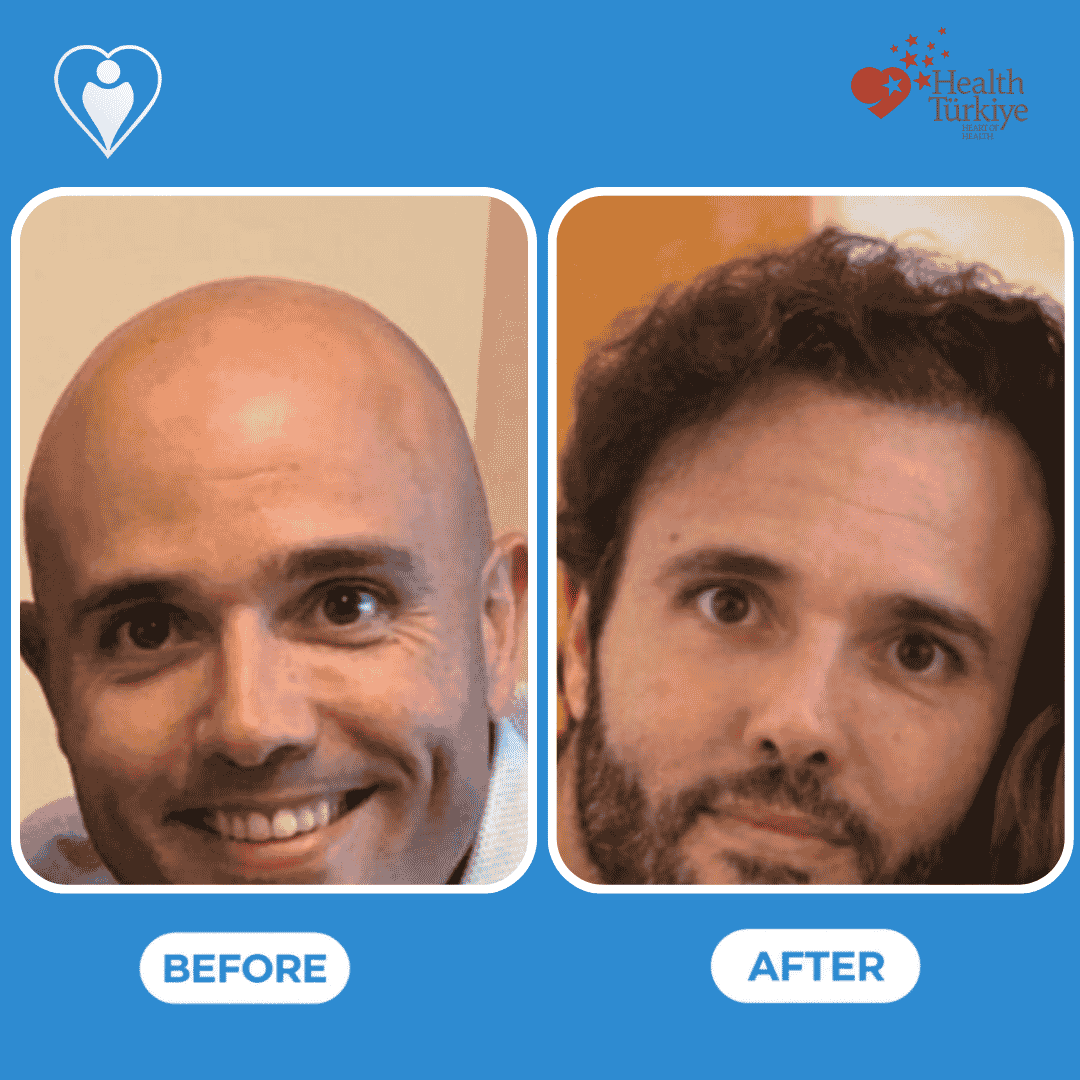 Before and after photos of a hair transplant procedure, front view of the hairline.