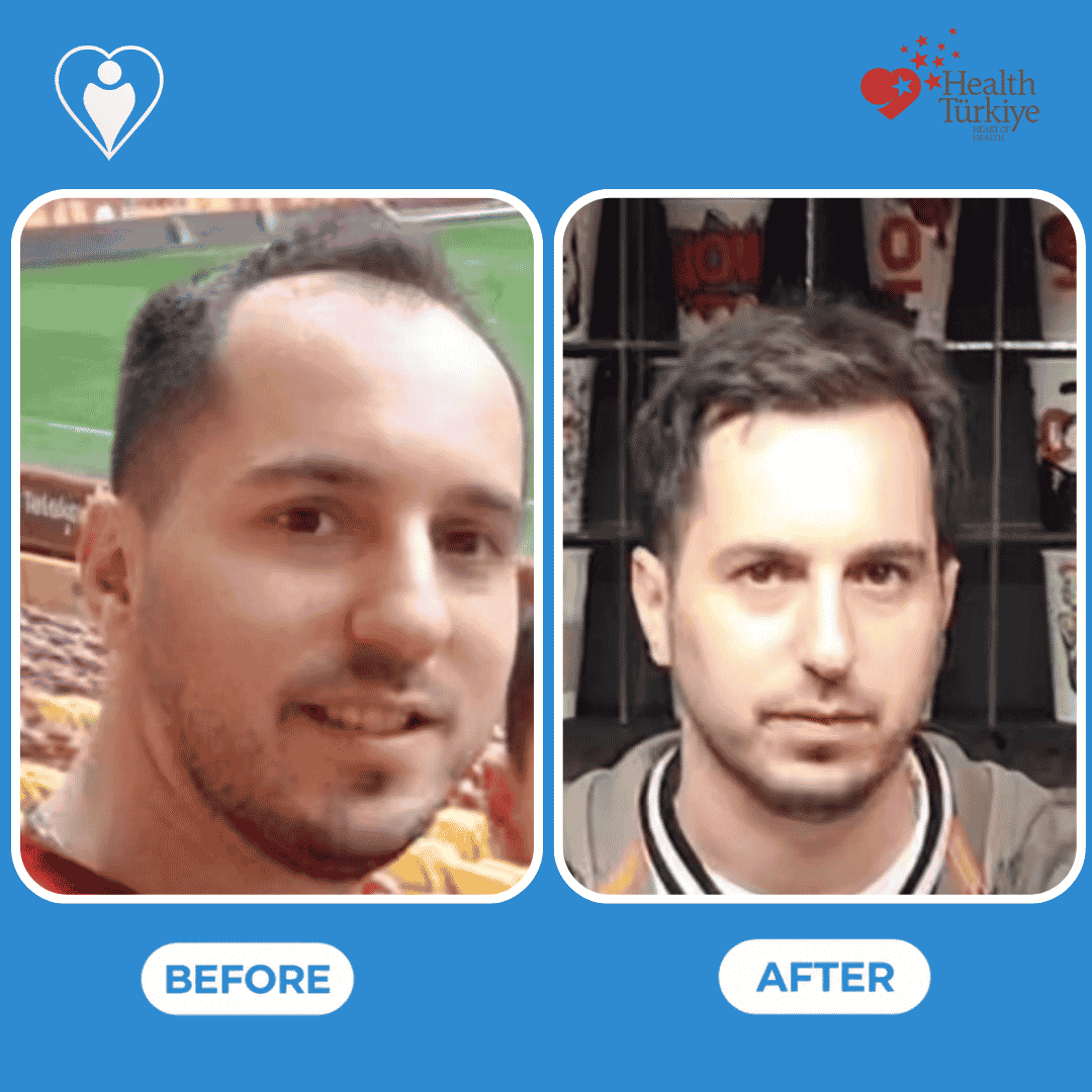 Before and after photos of a hair transplant procedure, side profile view of the hairline.