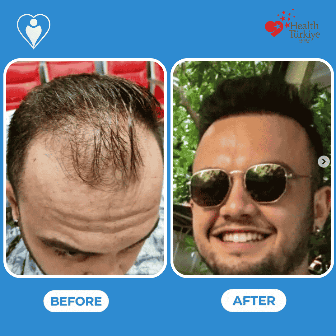 Before and after photos of a hair transplant procedure, close front view of the hairline.