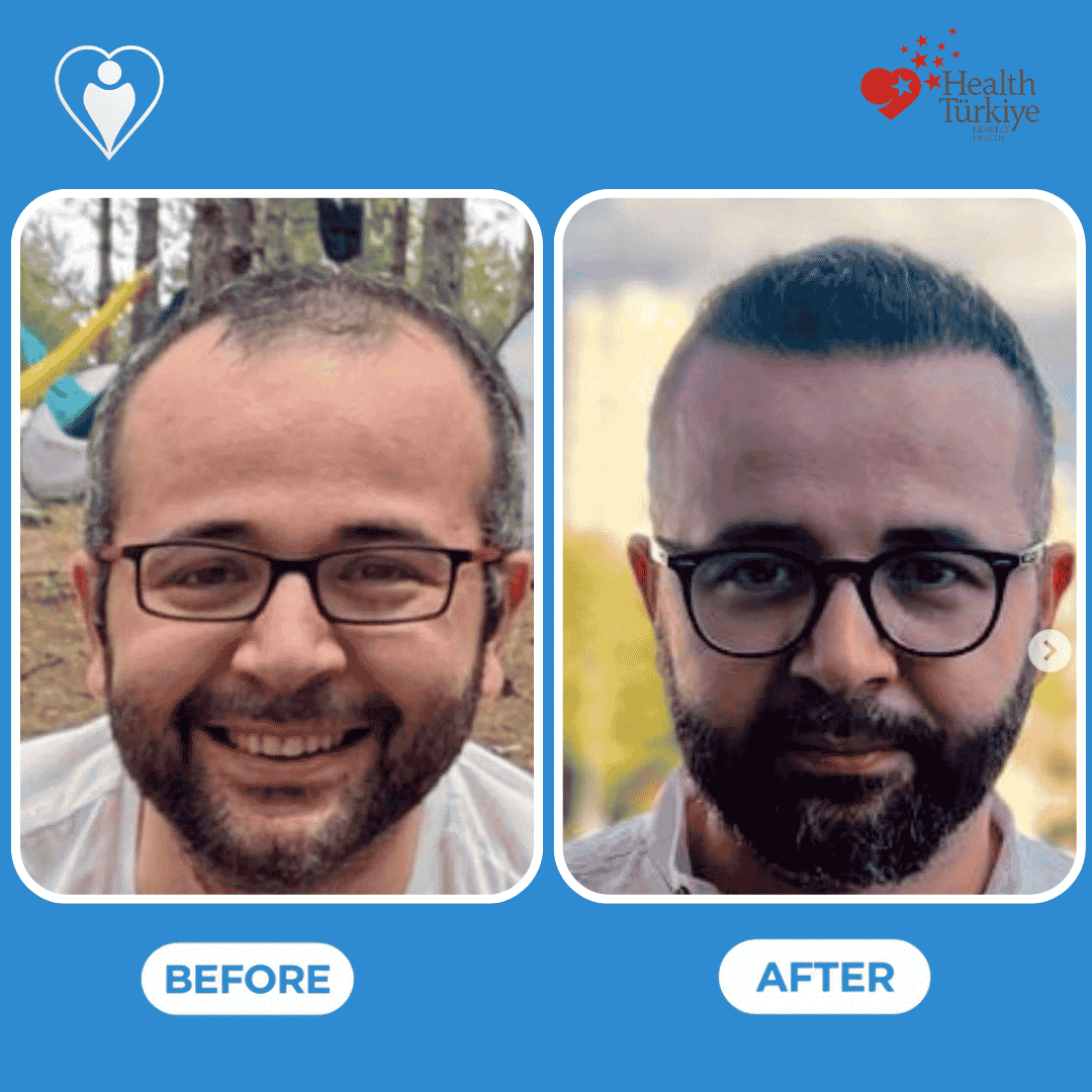 Before and after photos of a hair transplant procedure, top-down view of curly hair regrowth.