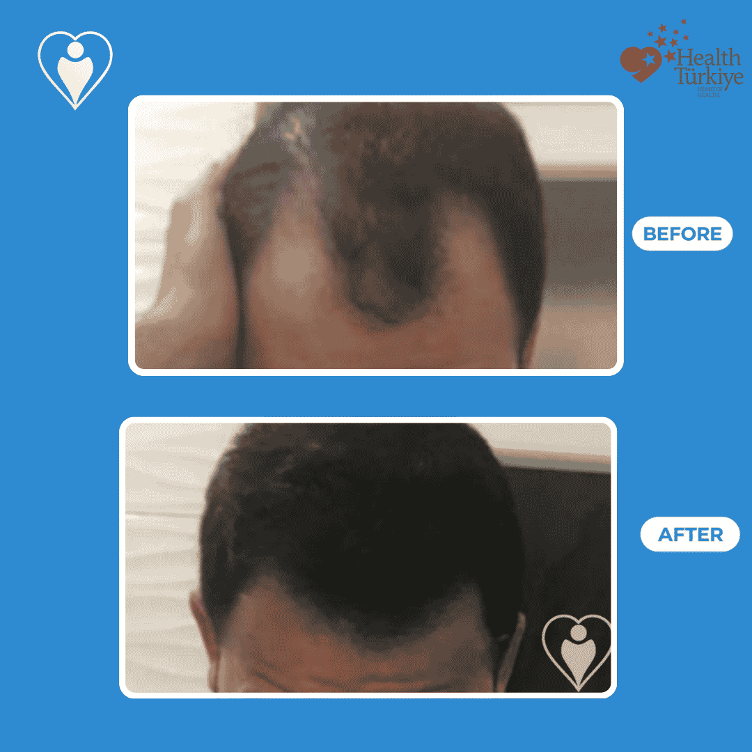Before and after photos of a hair transplant procedure, close view of the crown area.
