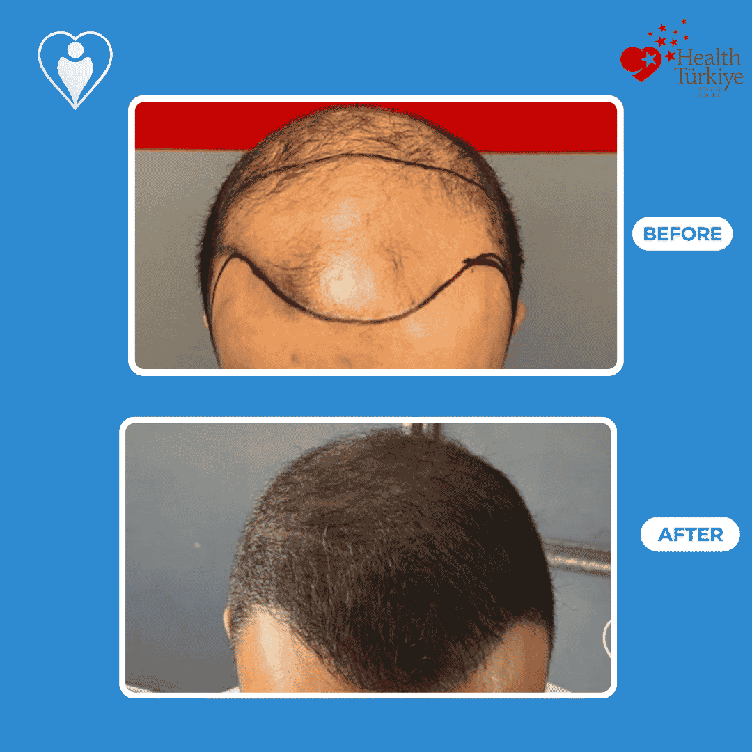 Before and after photos of a hair transplant procedure, top view with the hairline marked before surgery.
