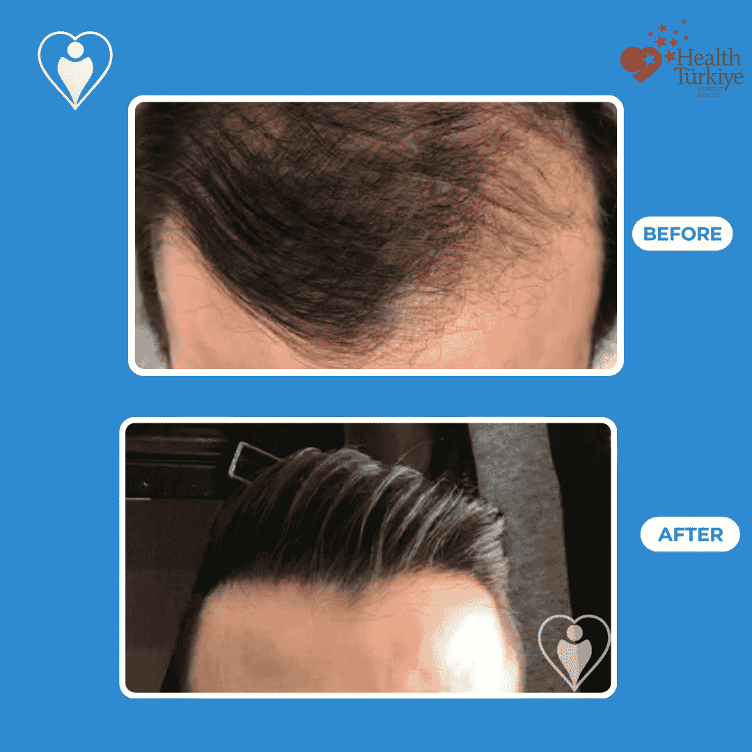 Before and after photos of a hair transplant procedure, close view of the frontal hairline.