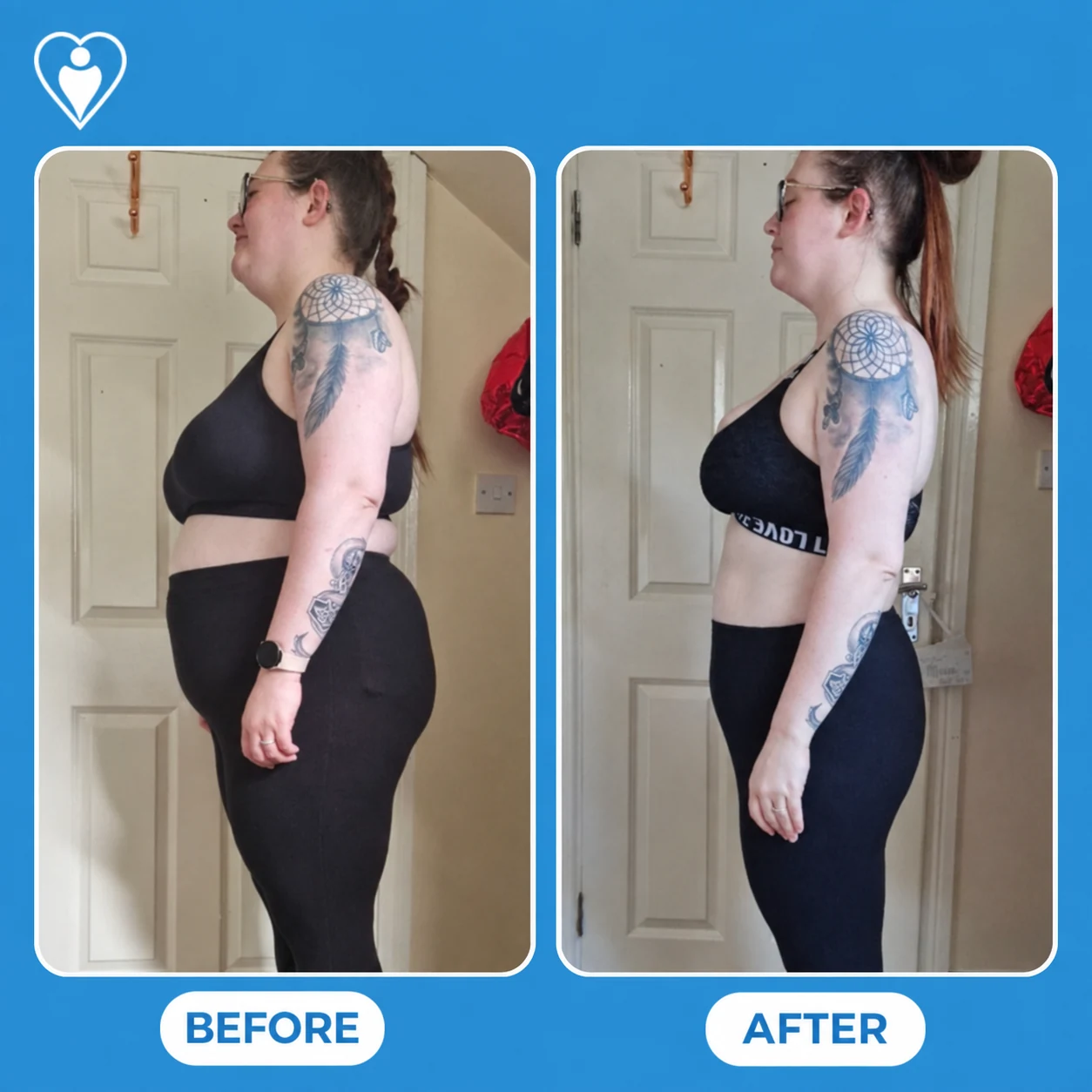 Bariatric surgery before and after: a woman photographed from the side in a sports bra and leggings before and after, patient of Assoc. Prof. Muhammed Zübeyr Üçüncü, Flymedi.