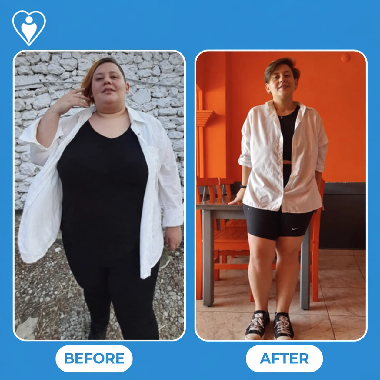 Weight loss surgery in Turkey, before and after: a woman in a white shirt and black trousers before, and in a white shirt and shorts after, patient of Assoc. Prof. Muhammed Zübeyr Üçüncü, Flymedi.