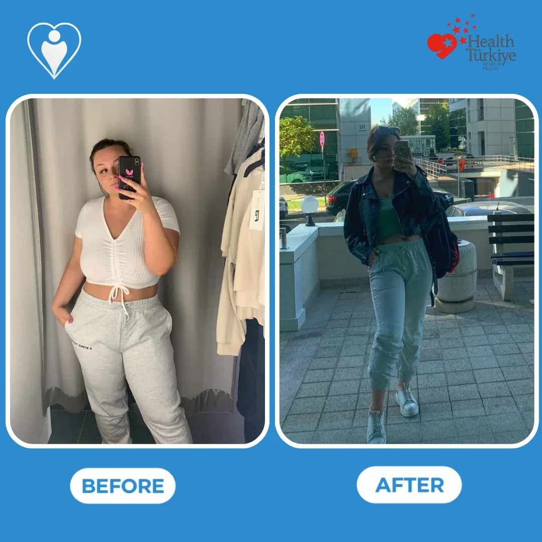 Bariatric surgery in Turkey, before and after: a woman in a white crop top and grey joggers in a fitting room mirror selfie before, and in a leather jacket, green top and light joggers outdoors after, patient of Assoc. Prof. Muhammed Zübeyr Üçüncü, Flymedi.
