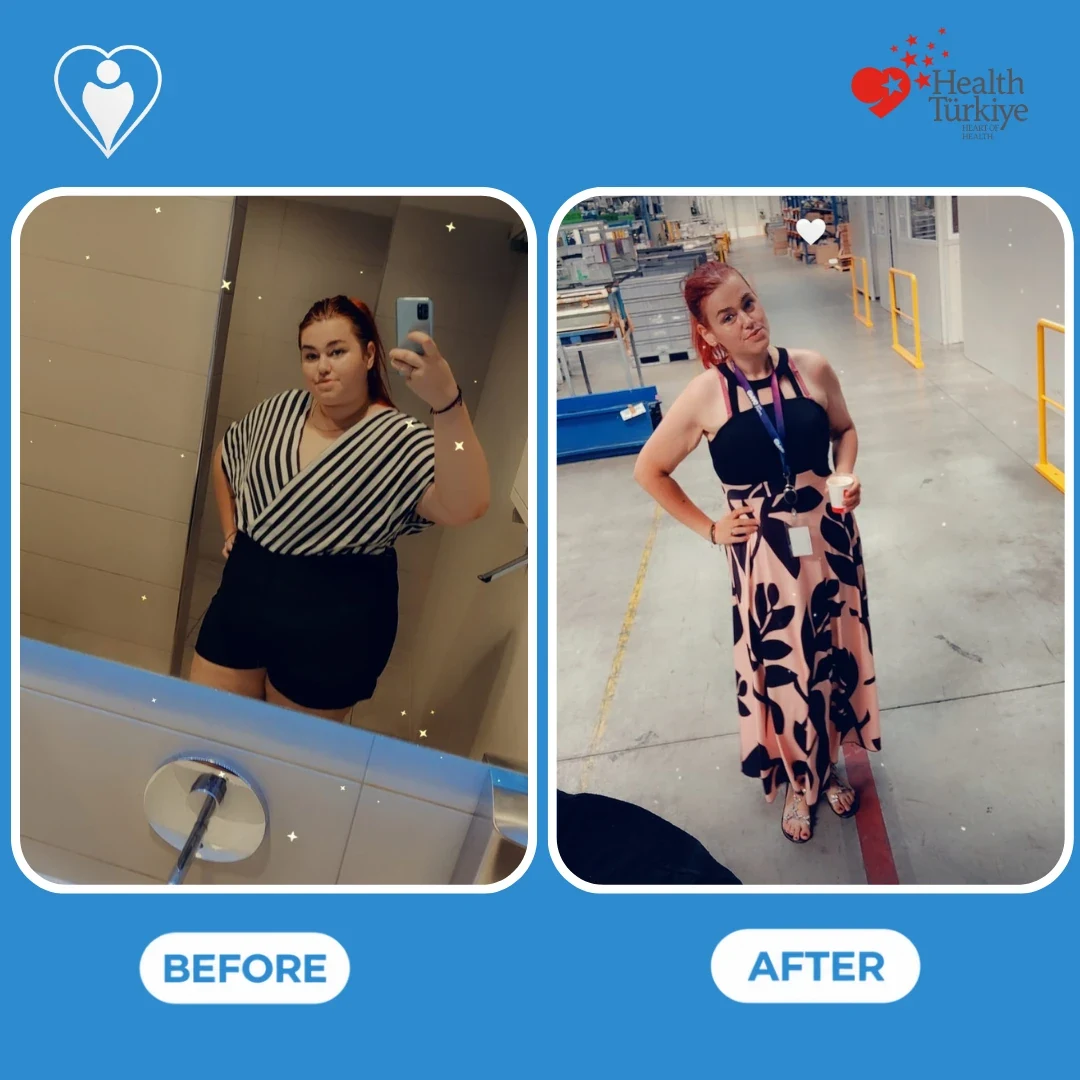 Weight loss surgery results: a woman in a striped top and black shorts in a mirror selfie before, and in a long black and pink patterned dress at work after, patient of Assoc. Prof. Muhammed Zübeyr Üçüncü, Flymedi.
