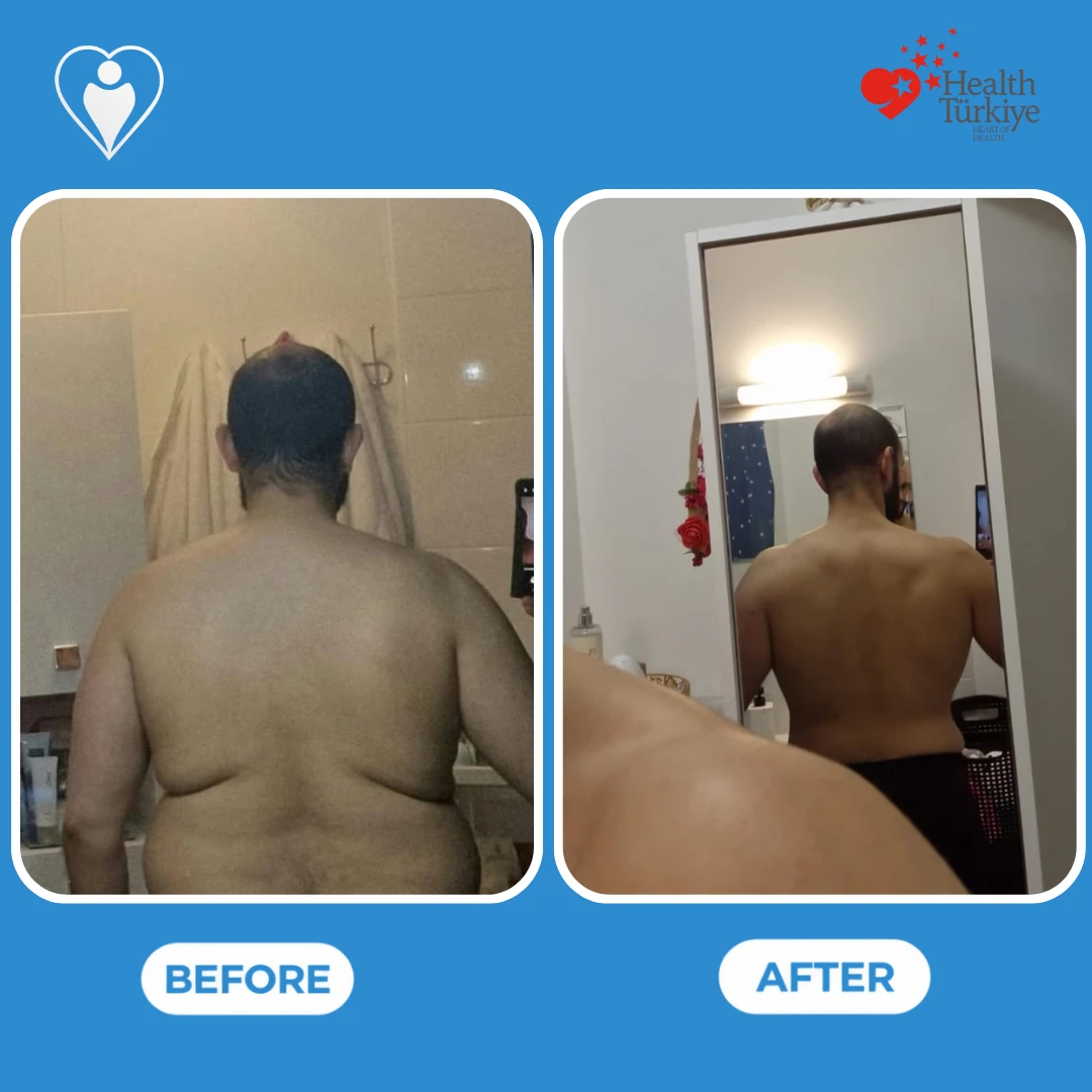 Bariatric surgery before and after pictures: the back of a man without a shirt before and after, both in mirror selfies, patient of Assoc. Prof. Muhammed Zübeyr Üçüncü, Flymedi.