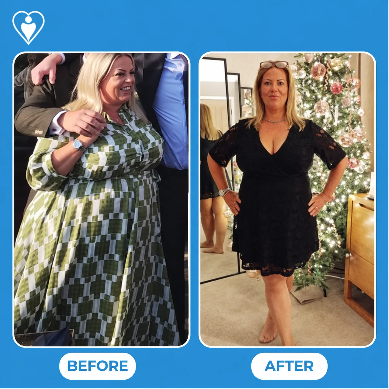 Bariatric surgery before and after: a woman in a green patterned dress at an event before, and in a black lace dress at home after, patient of Prof. Mustafa Uygar Kalaycı, Flymedi.