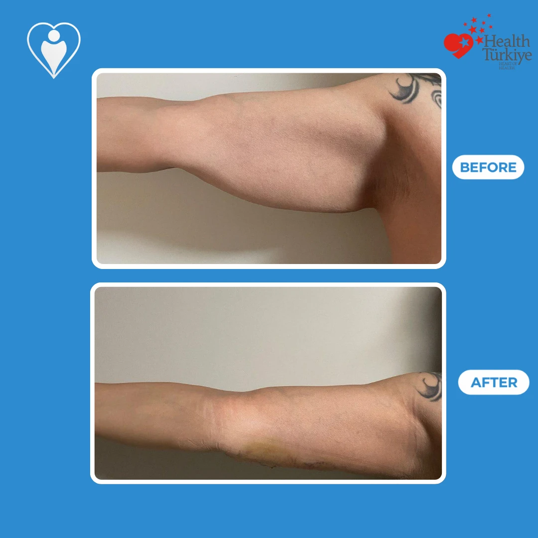 Arm surgery before and after: view of an outstretched upper arm with loose, hanging skin before and a slimmer, tighter contour after, with light bruising, patient of Assoc. Prof. Ömer Faruk Koçak, Flymedi.
