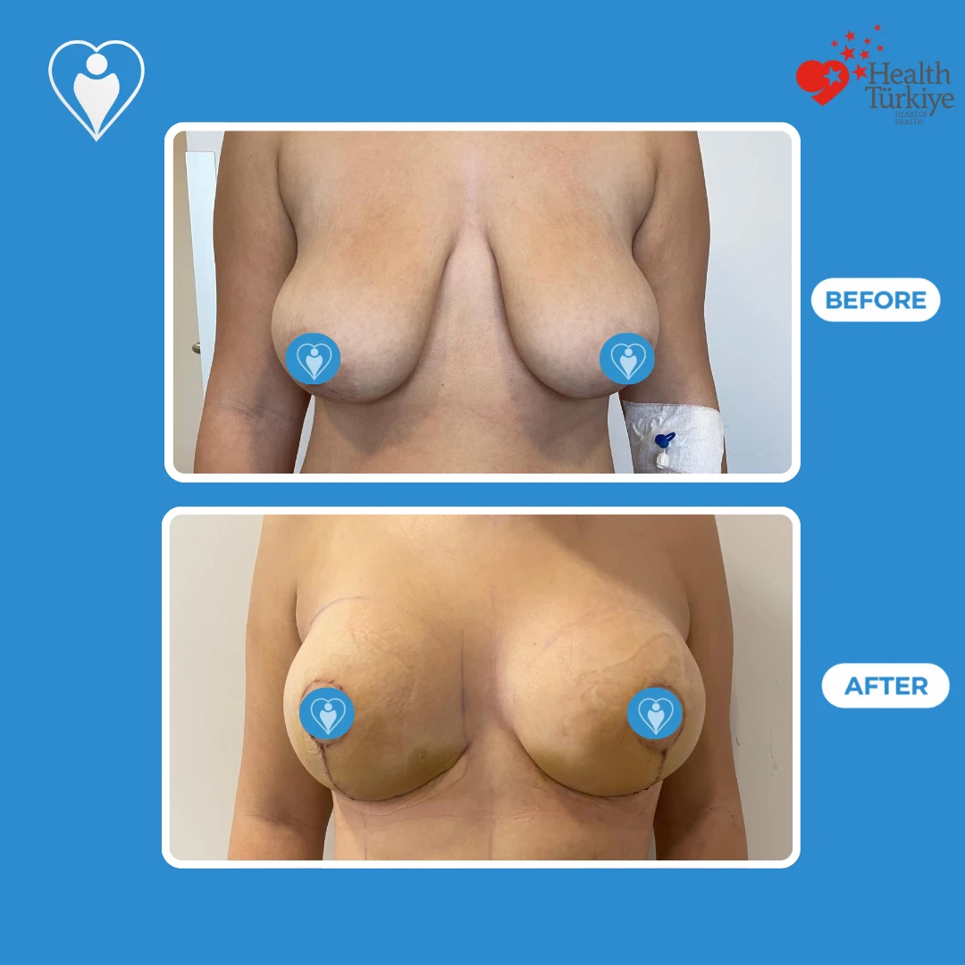 Breast surgery in Istanbul, before and after: front view of heavy, sagging breasts before and a higher, lifted shape soon after surgery, with fine scars, patient of Assoc. Prof. Ömer Faruk Koçak, Flymedi.