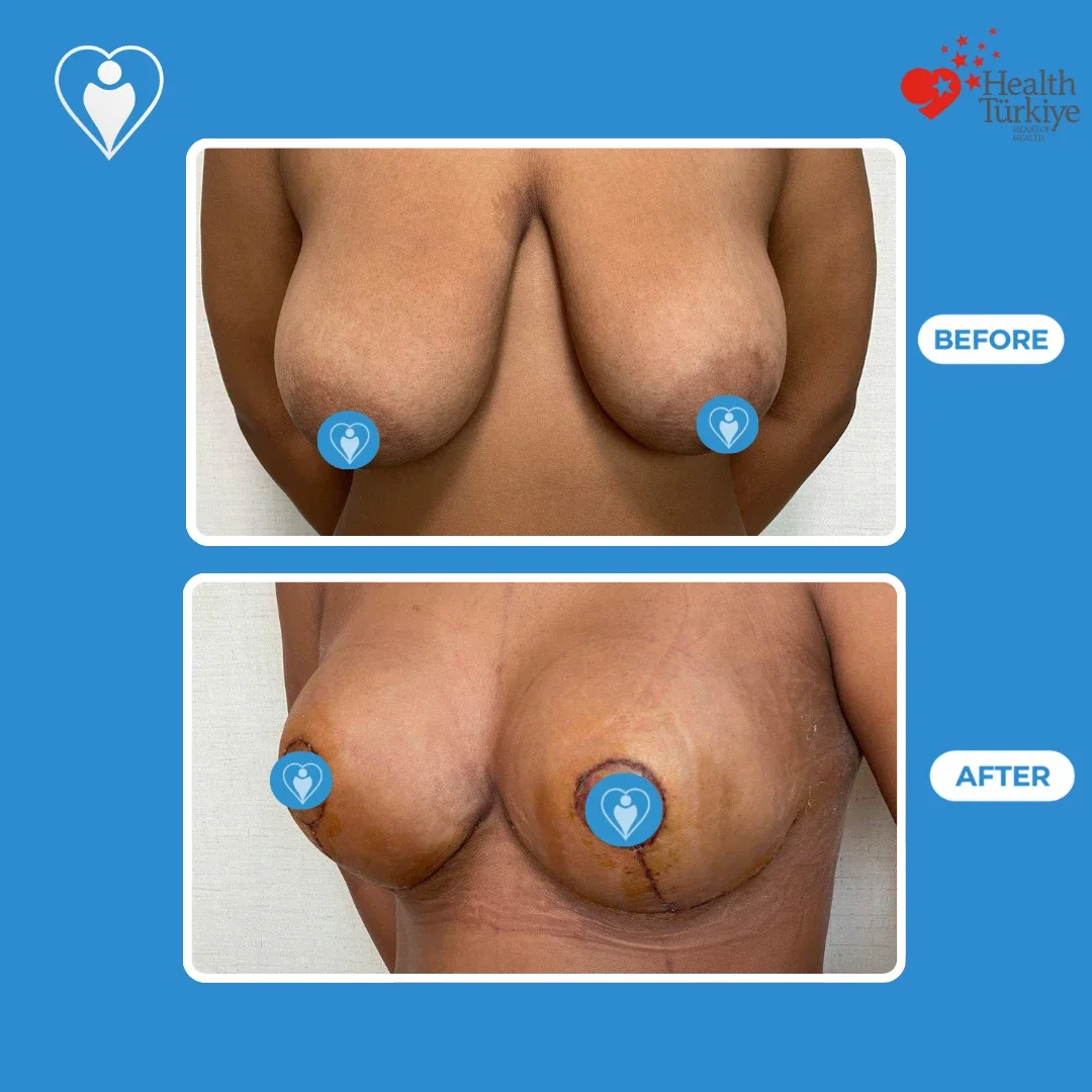 Breast surgery in Turkey, before and after: front view of large, low breasts before and a rounder, higher shape soon after surgery, with stitches, patient of Assoc. Prof. Ömer Faruk Koçak, Flymedi.