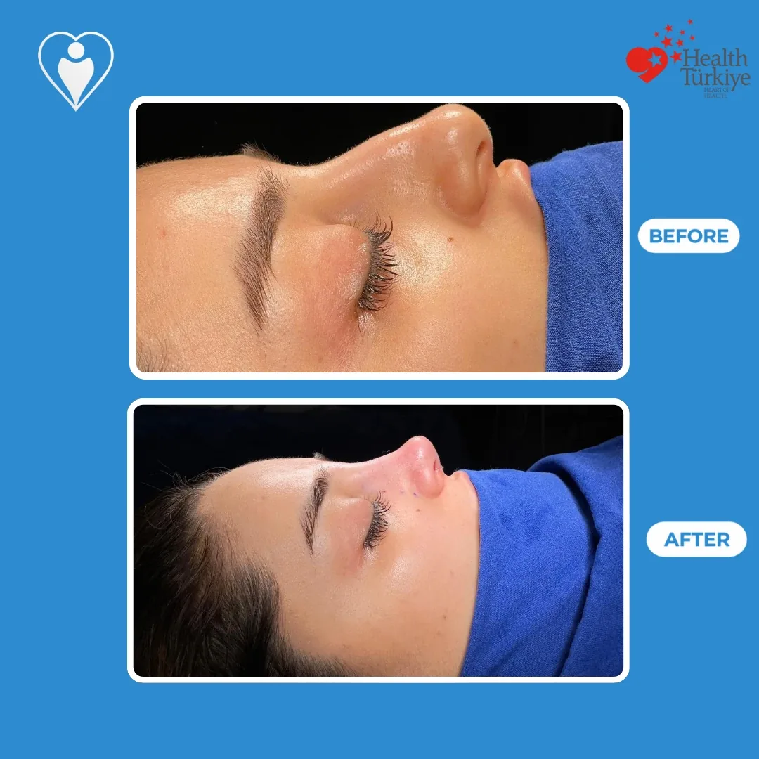 Nose surgery before and after: side profile of a woman's nose with a fuller bridge and tip before and a smaller, straighter profile after, patient of Assoc. Prof. Ömer Faruk Koçak, Flymedi.