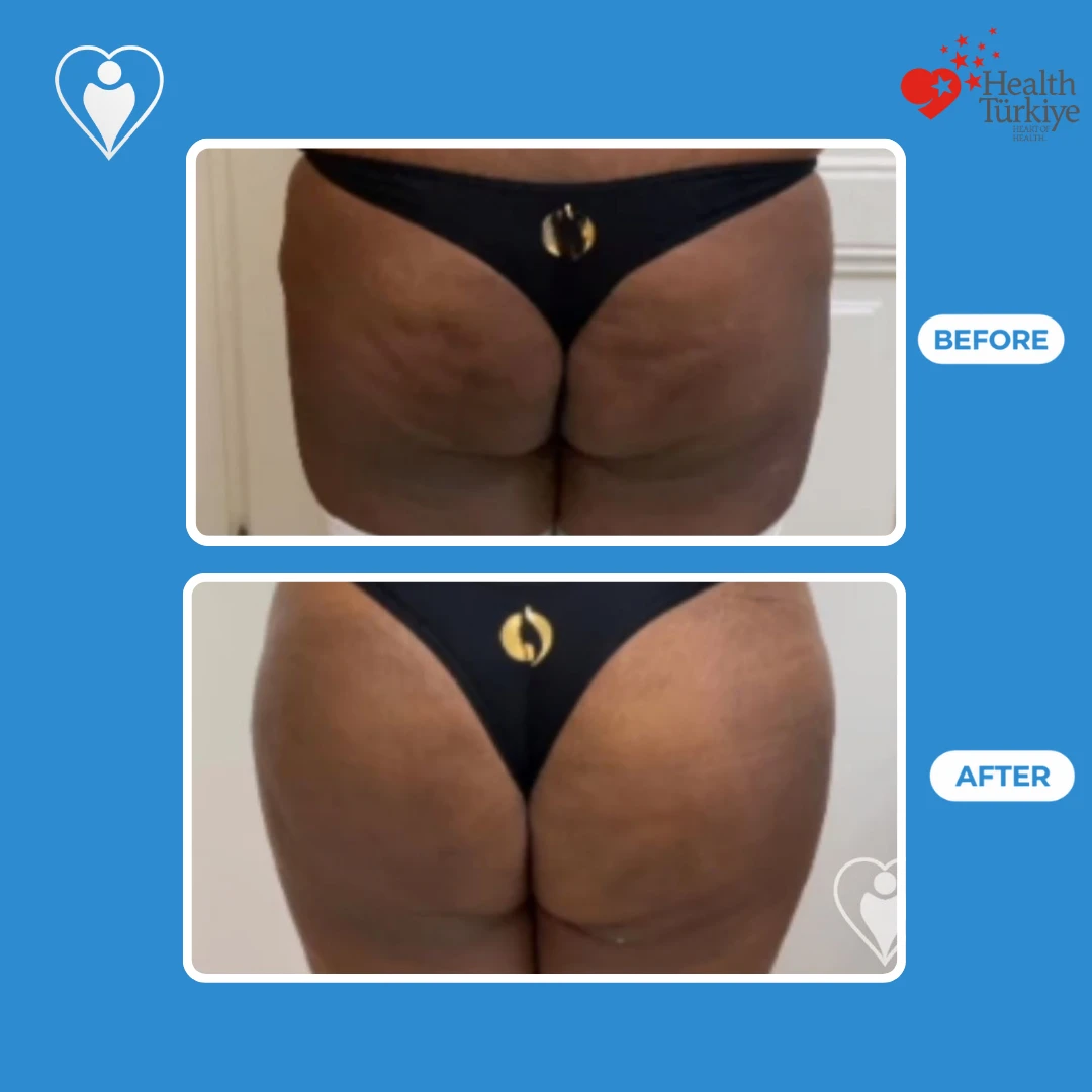 Buttock surgery before and after: back view of a woman in black underwear before and after, with a rounder, fuller buttock shape, patient of Op. Dr. Ömer Sağır, Flymedi.