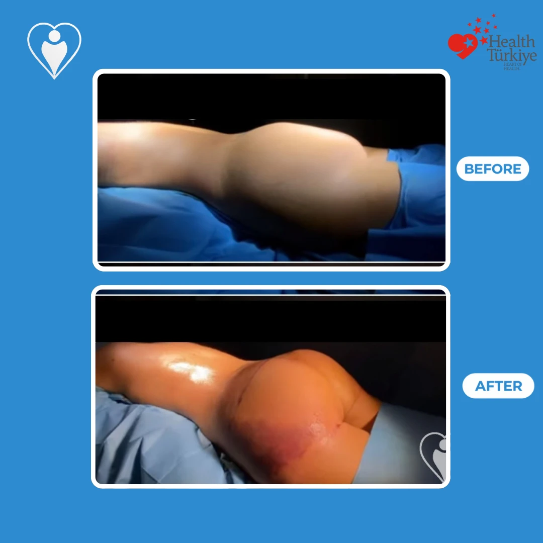 Plastic surgery in Istanbul, before and after: side view of a woman's buttocks on the operating table before and just after surgery, with fresh bruising, patient of Op. Dr. Ömer Sağır, Flymedi.