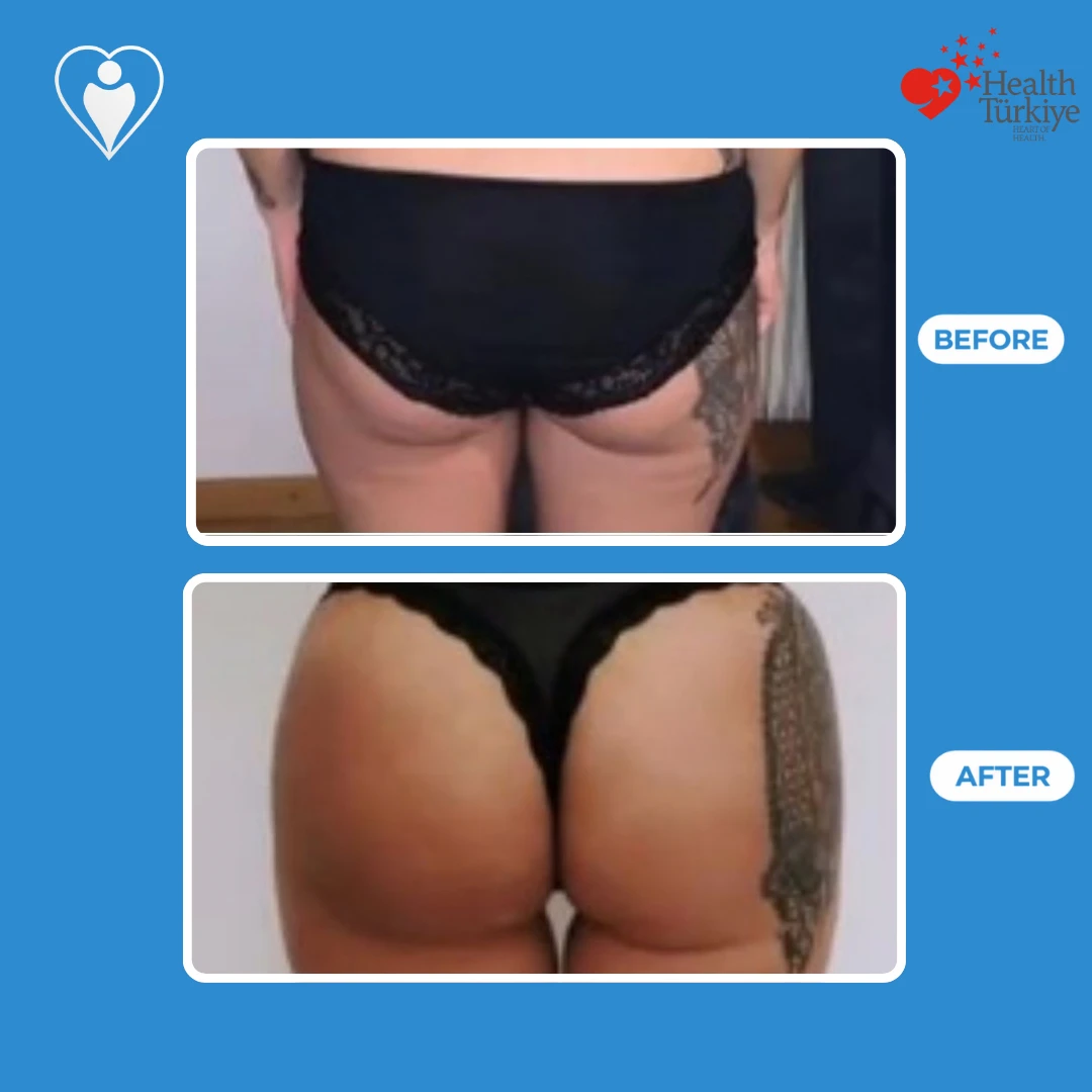 Body contouring before and after: back view of a woman with a thigh tattoo before and after, buttocks lifted and fuller, patient of Op. Dr. Ömer Sağır, Flymedi.