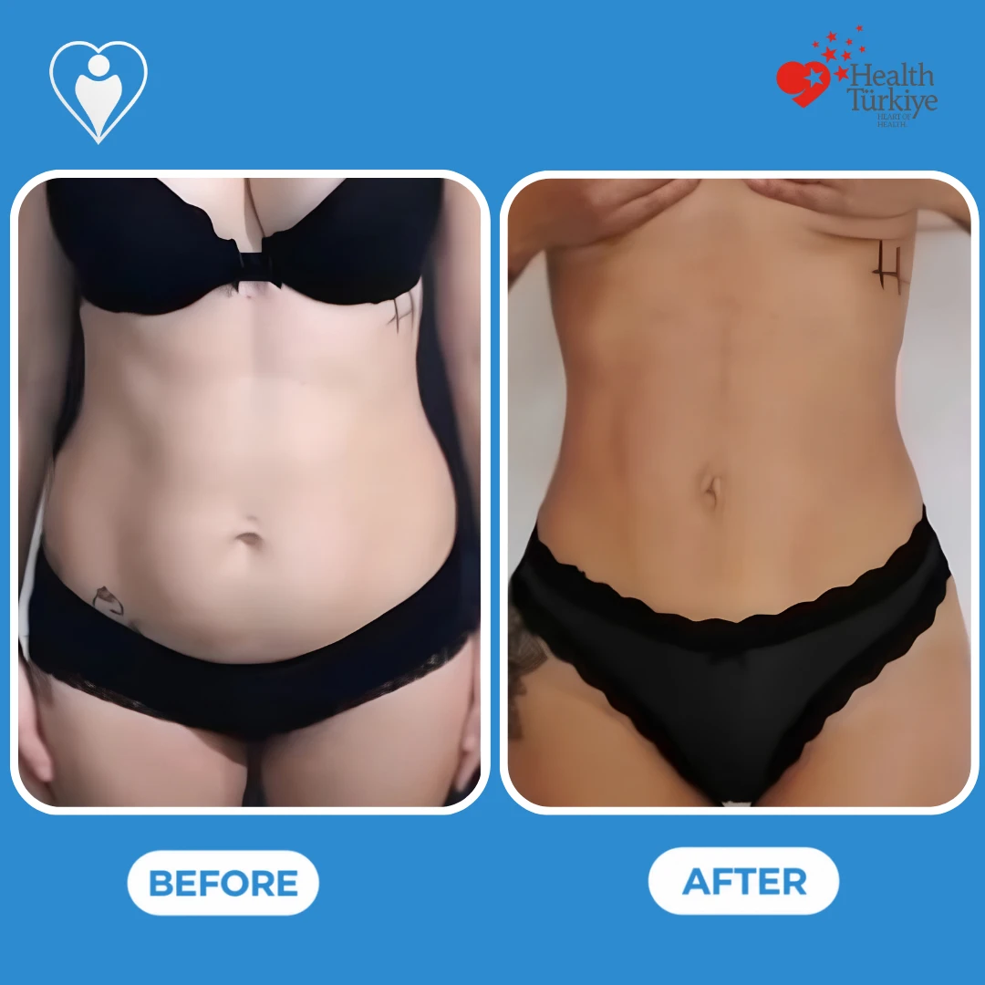 Cosmetic surgery before and after: front view of a woman's abdomen and waist before and after, with a flatter stomach and narrower waist, patient of Op. Dr. Ömer Sağır, Flymedi.