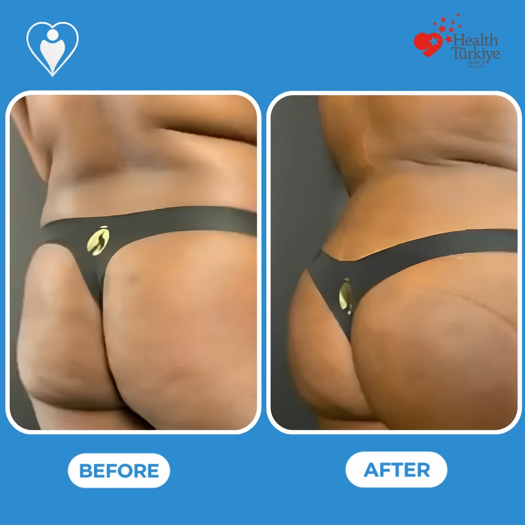 Plastic surgery before and after: oblique back view of a woman's buttocks and hips before and after, with a fuller, smoother contour, patient of Op. Dr. Ömer Sağır, Flymedi.