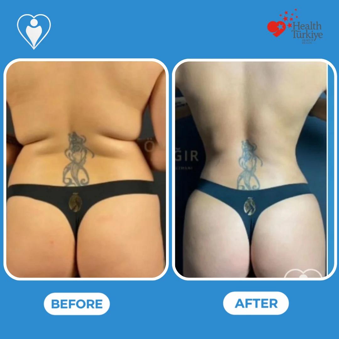 Body contouring in Istanbul, before and after: back view of a woman with a lower back tattoo before and after, with a slimmer waist and smoother flanks, patient of Op. Dr. Ömer Sağır, Flymedi.