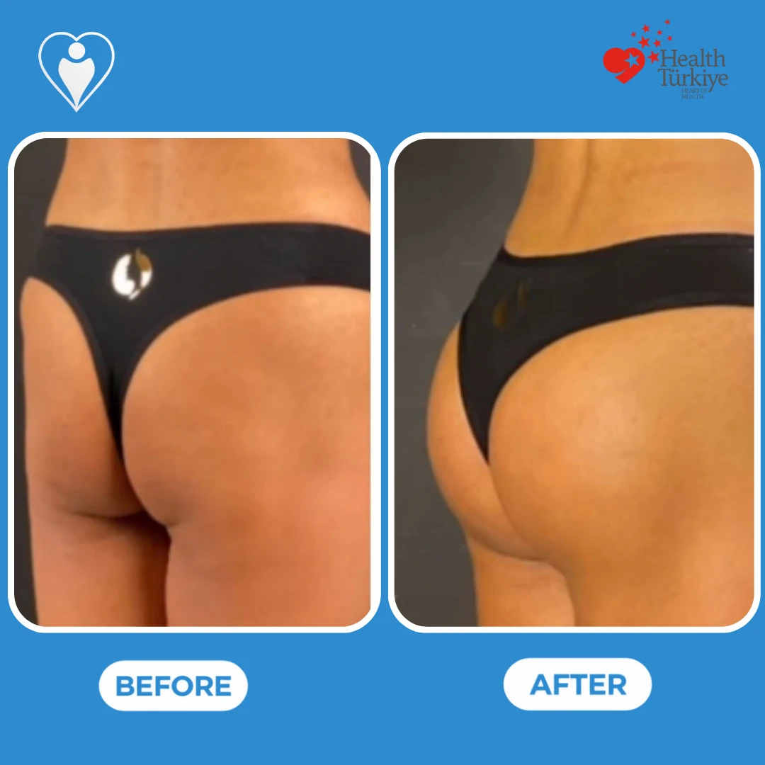 Plastic surgery in Turkey, before and after: oblique back view of a woman's buttocks before and after, with more projection and a rounder shape, patient of Op. Dr. Ömer Sağır, Flymedi.