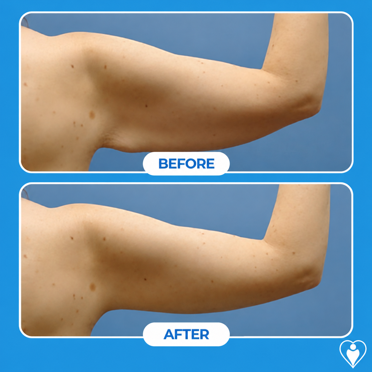 Lifting de brazos antes y después: una vista de espalda con el brazo superior más lleno antes, y un brazo tonificado después, paciente del Dr. Özge Ergün, Flymedi.