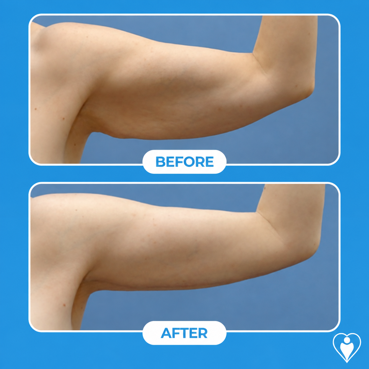 Braquioplastia antes y después: el brazo de una mujer antes, y con un contorno más delgado después, paciente del Dr. Özge Ergün, Flymedi.