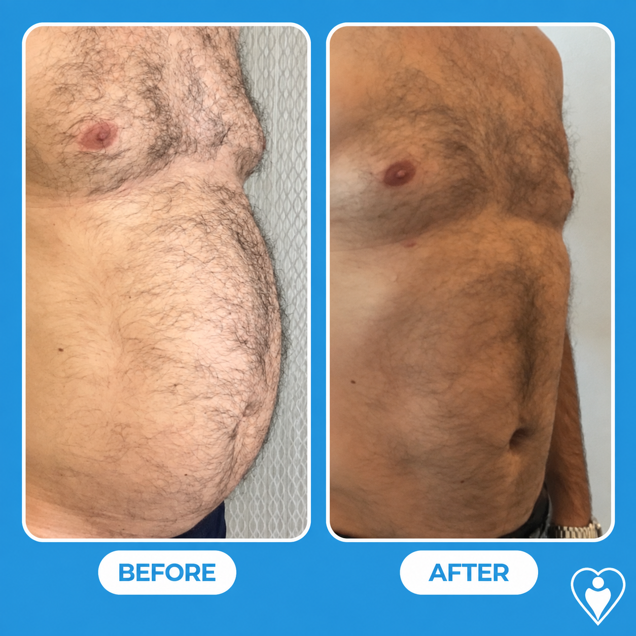 Reducción de senos masculina antes y después: el pecho de un hombre antes, y después de la cirugía de ginecomastia, paciente del Dr. Özge Ergün, Flymedi.