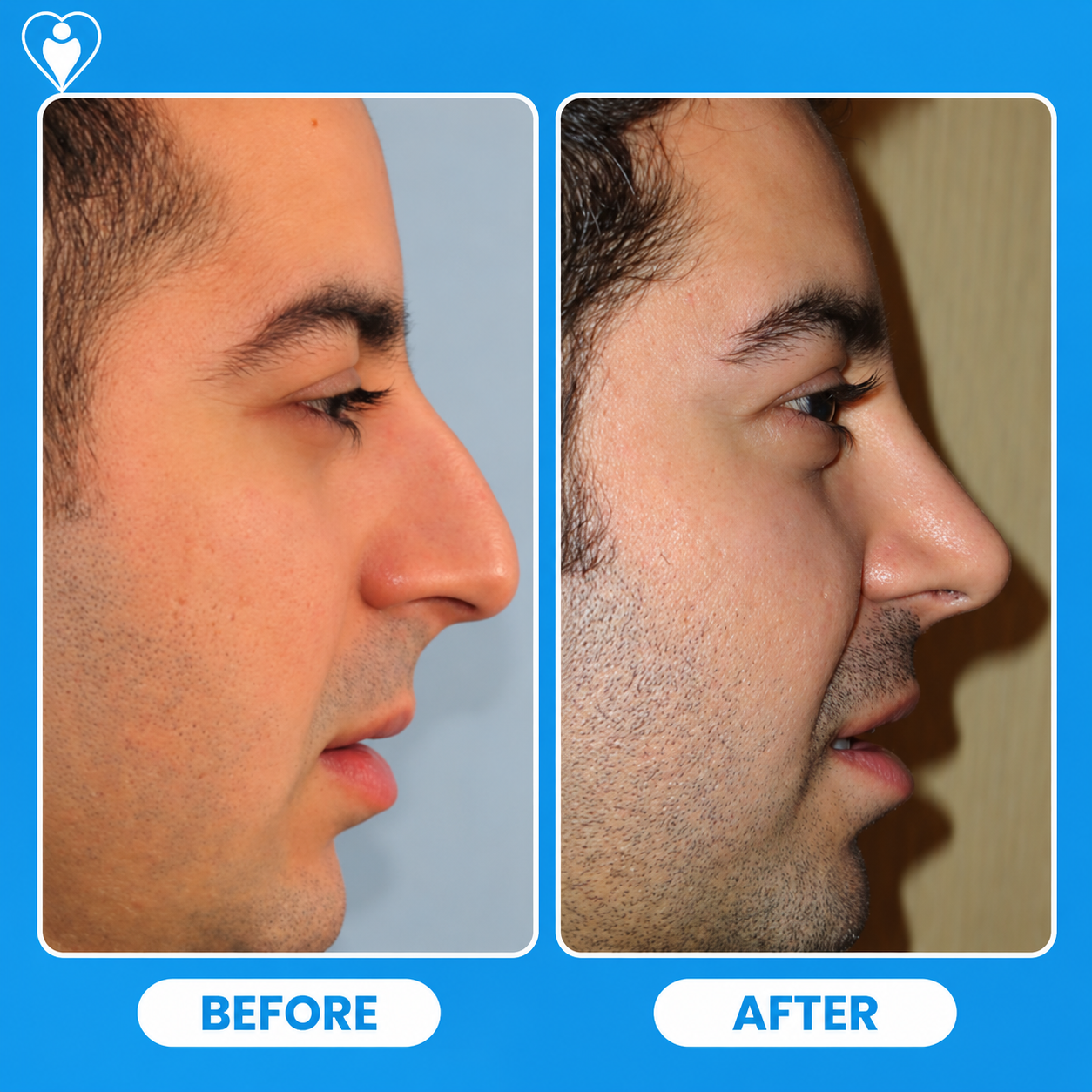 Rinoplastia antes y después: el perfil lateral de un hombre antes, y después de remodelar la nariz, paciente del Dr. Özge Ergün, Flymedi.