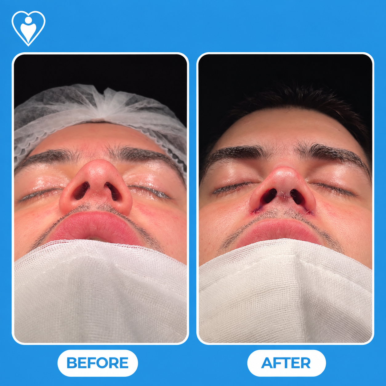 Rhinoplasty before and after: a patient in a surgical cap and gauze before, and with visible nostril sutures after, patient of Assoc. Prof. Raşit Cevizci, Flymedi.
