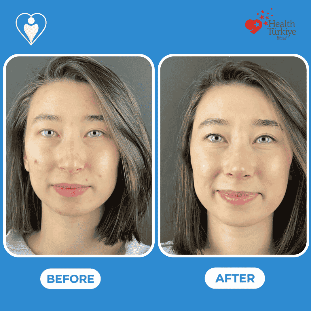 Rhinoplasty in Turkey, before and after: a woman's front view before, and after nose reshaping, patient of Assoc. Prof. Raşit Cevizci, Flymedi.