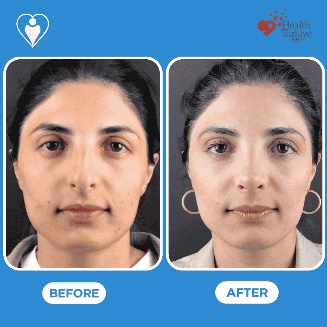 Nose reshaping surgery before and after: a woman's front view before, and after rhinoplasty, patient of Assoc. Prof. Raşit Cevizci, Flymedi.