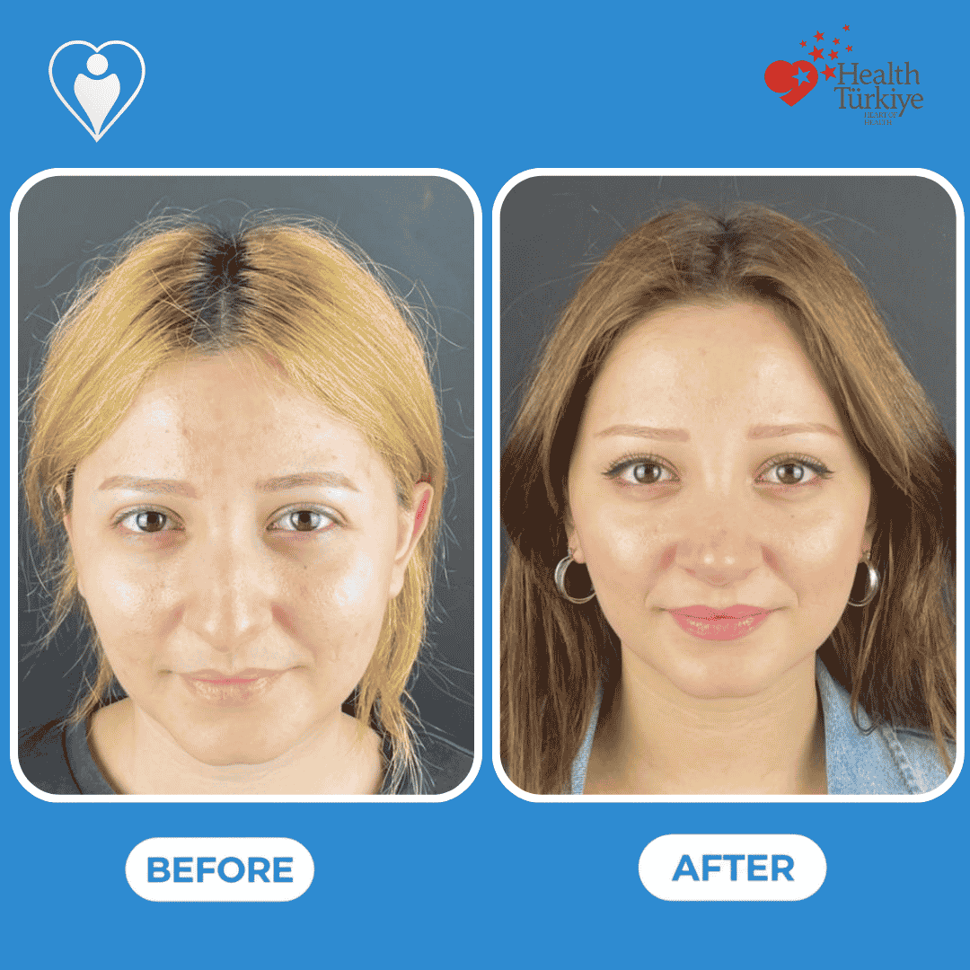 Rhinoplasty before and after: a woman's front view before, and after nose reshaping, patient of Assoc. Prof. Raşit Cevizci, Flymedi.