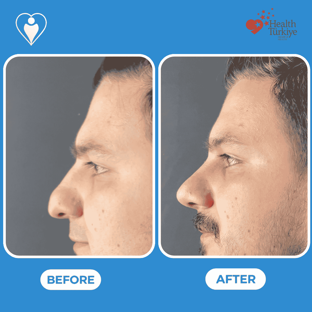 Nose surgery before and after: a man's side profile before, and after rhinoplasty, patient of Assoc. Prof. Raşit Cevizci, Flymedi.