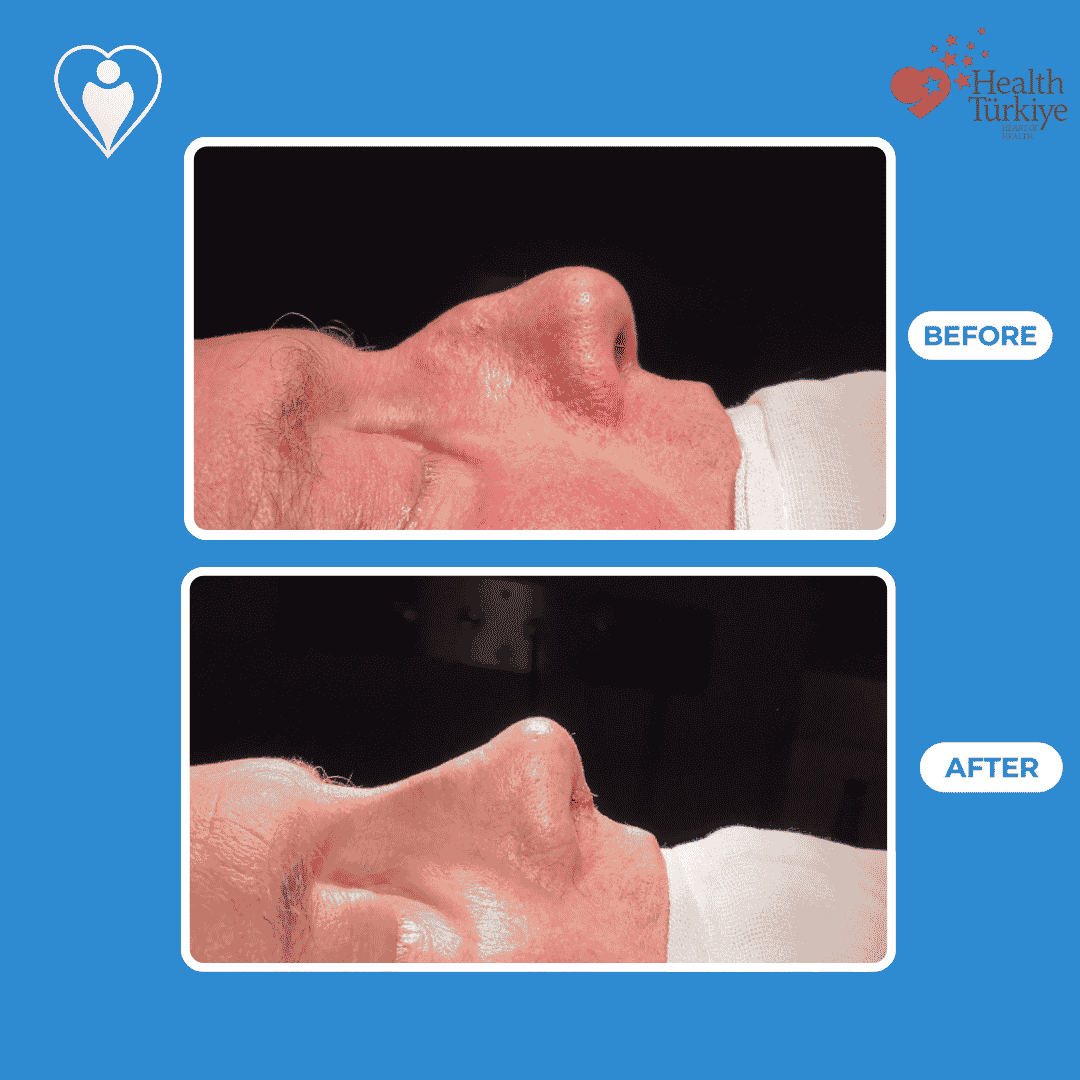 Rhinoplasty before and after: a close-up clinical view before, and after nose reshaping, patient of Assoc. Prof. Raşit Cevizci, Flymedi.