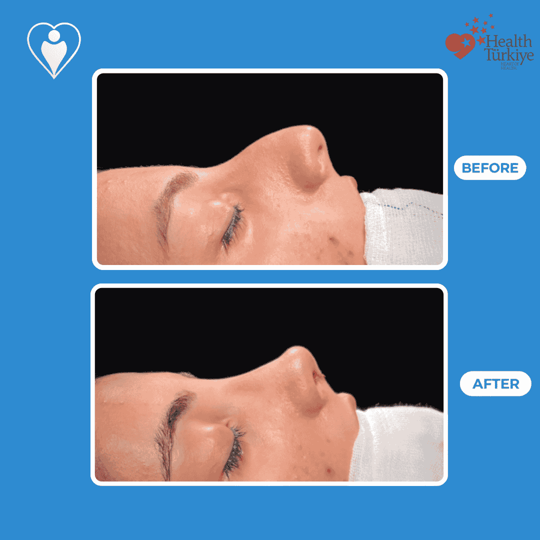 Nose reshaping surgery before and after: a close-up clinical view before, and after rhinoplasty, patient of Assoc. Prof. Raşit Cevizci, Flymedi.