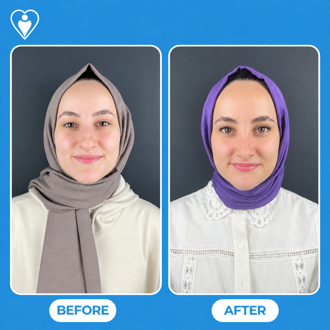 Nose surgery before and after: a woman in a grey headscarf before, and in a purple headscarf after, patient of Assoc. Prof. Raşit Cevizci, Flymedi.
