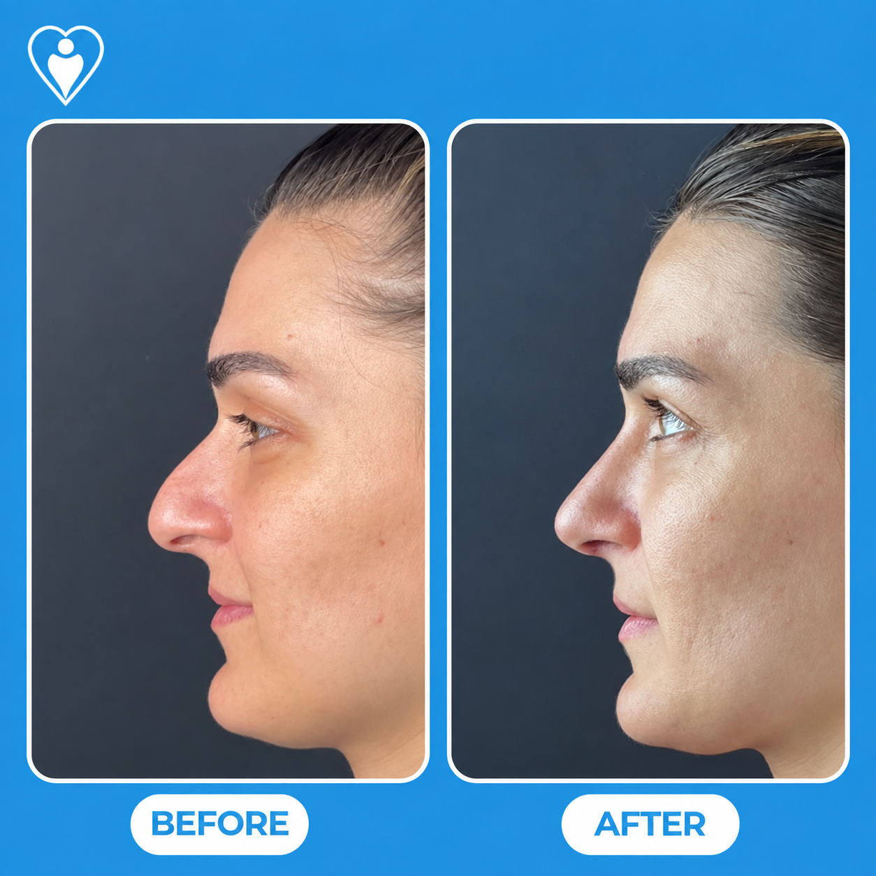 Rhinoplasty in Turkey, before and after: a woman's side profile before and after nose reshaping, patient of Assoc. Prof. Raşit Cevizci, Flymedi.