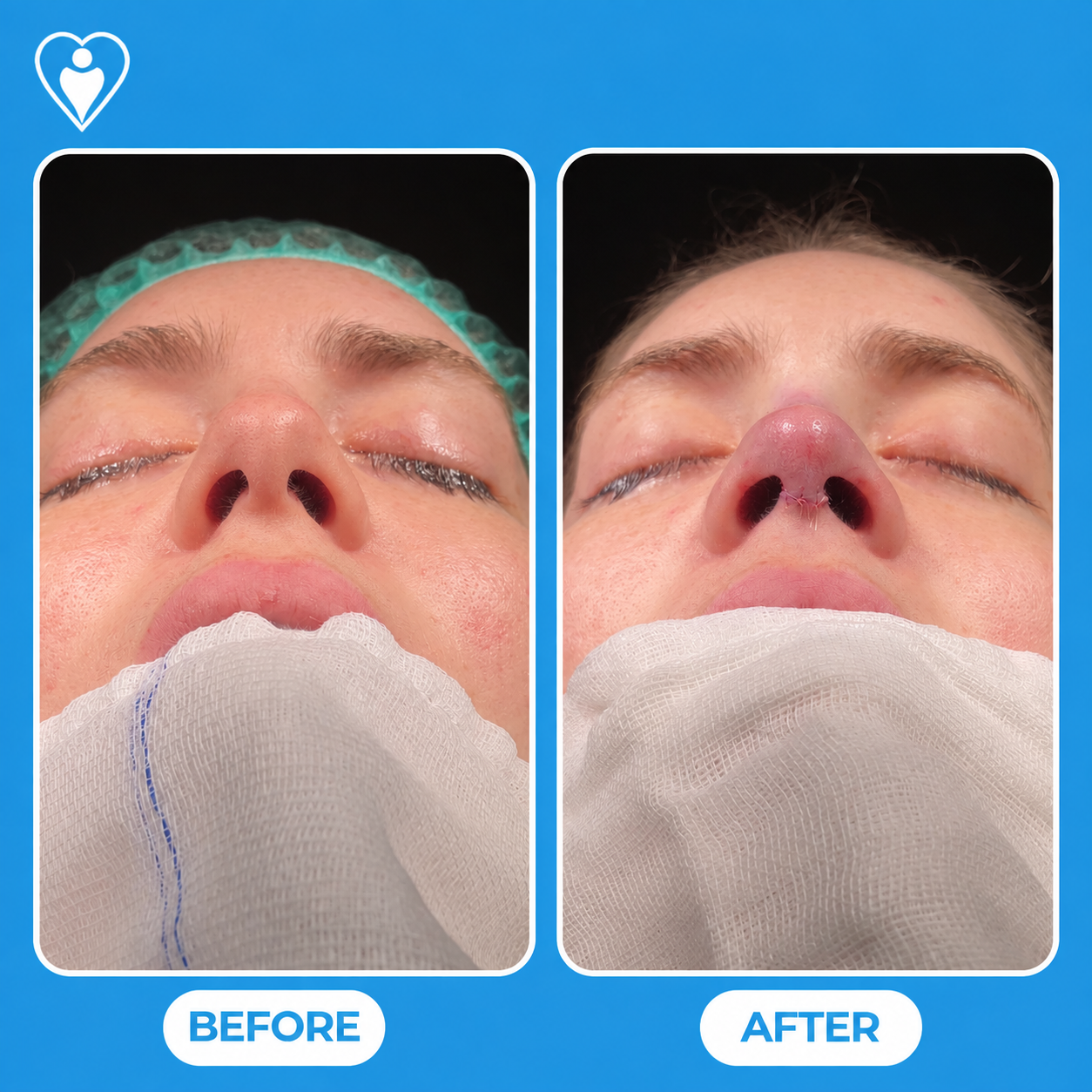 Nose surgery before and after: a close-up of the nose with surgical marking before, and with sutures healing after rhinoplasty, patient of Assoc. Prof. Raşit Cevizci, Flymedi.