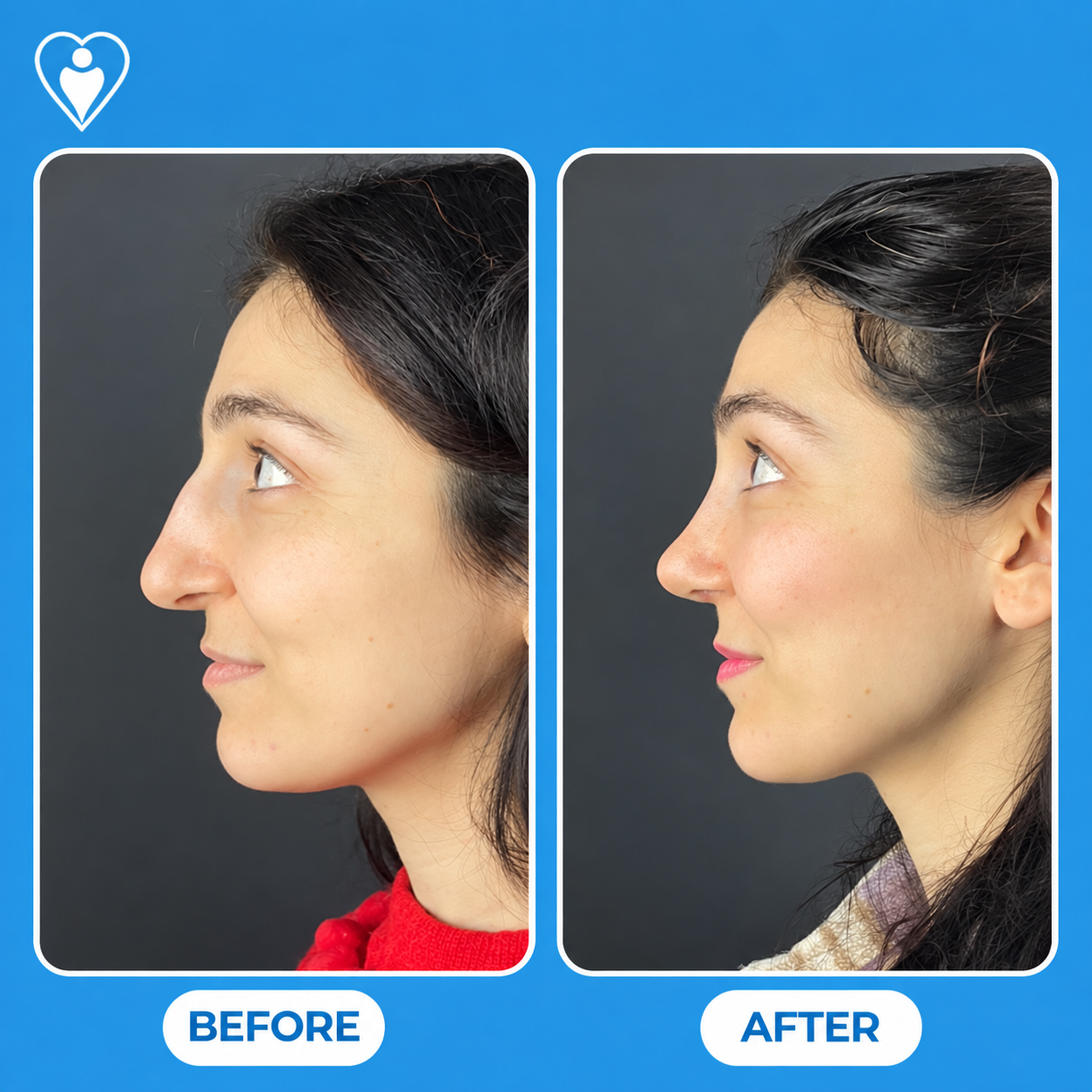 Rhinoplasty before and after: a woman in a red top before, and in a patterned top after, patient of Assoc. Prof. Raşit Cevizci, Flymedi.